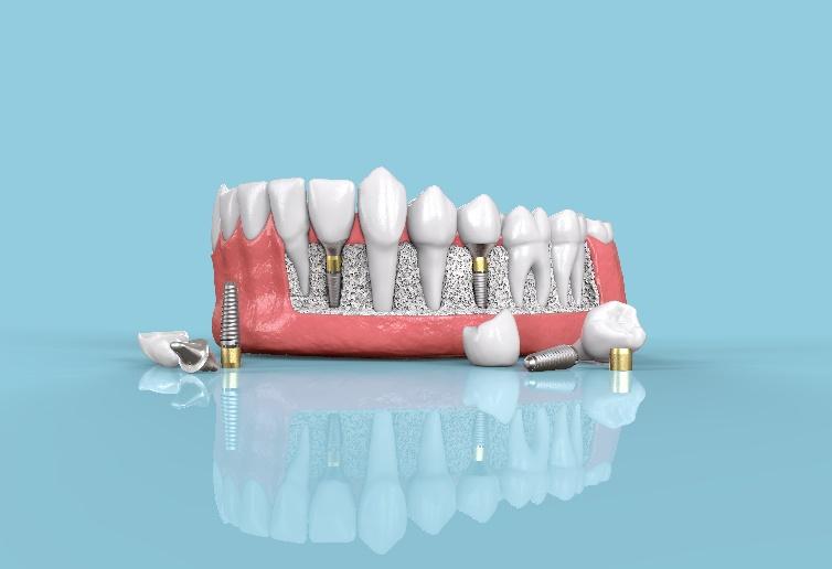 Restorative Dentistry Richmond VA