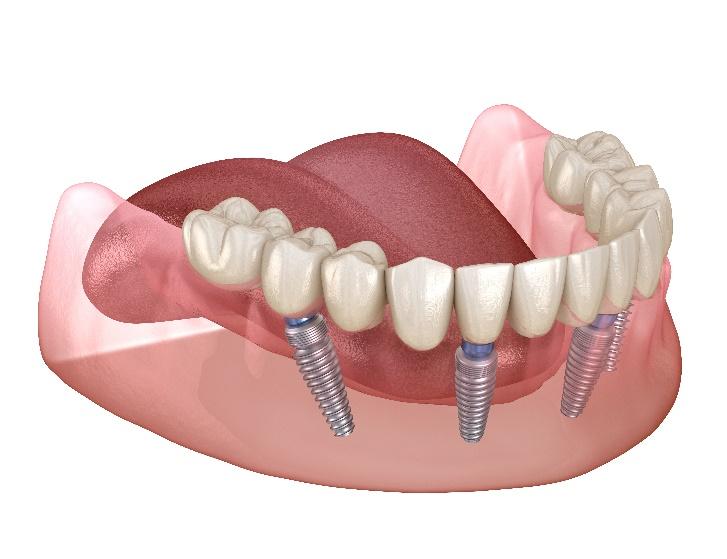 Dental Implants in Sandston, VA