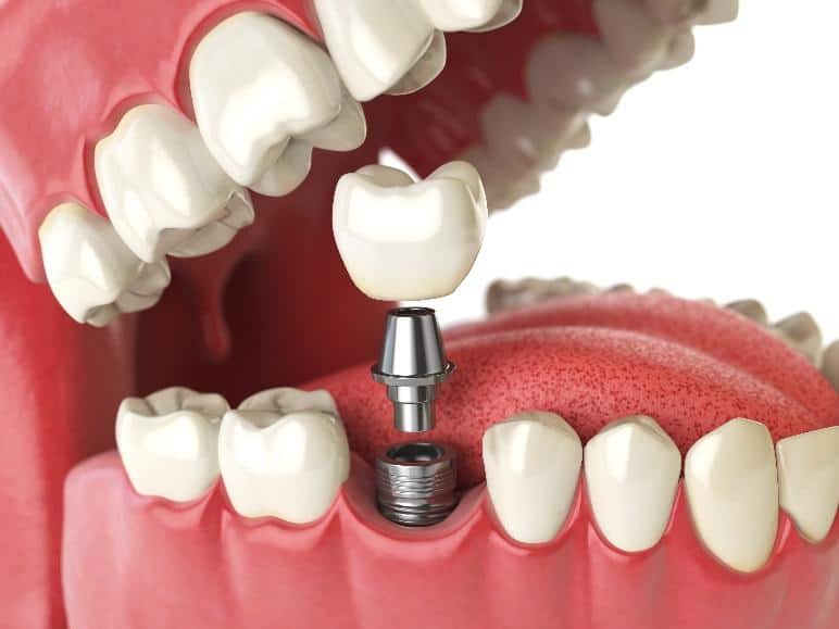 Dental implants Kent